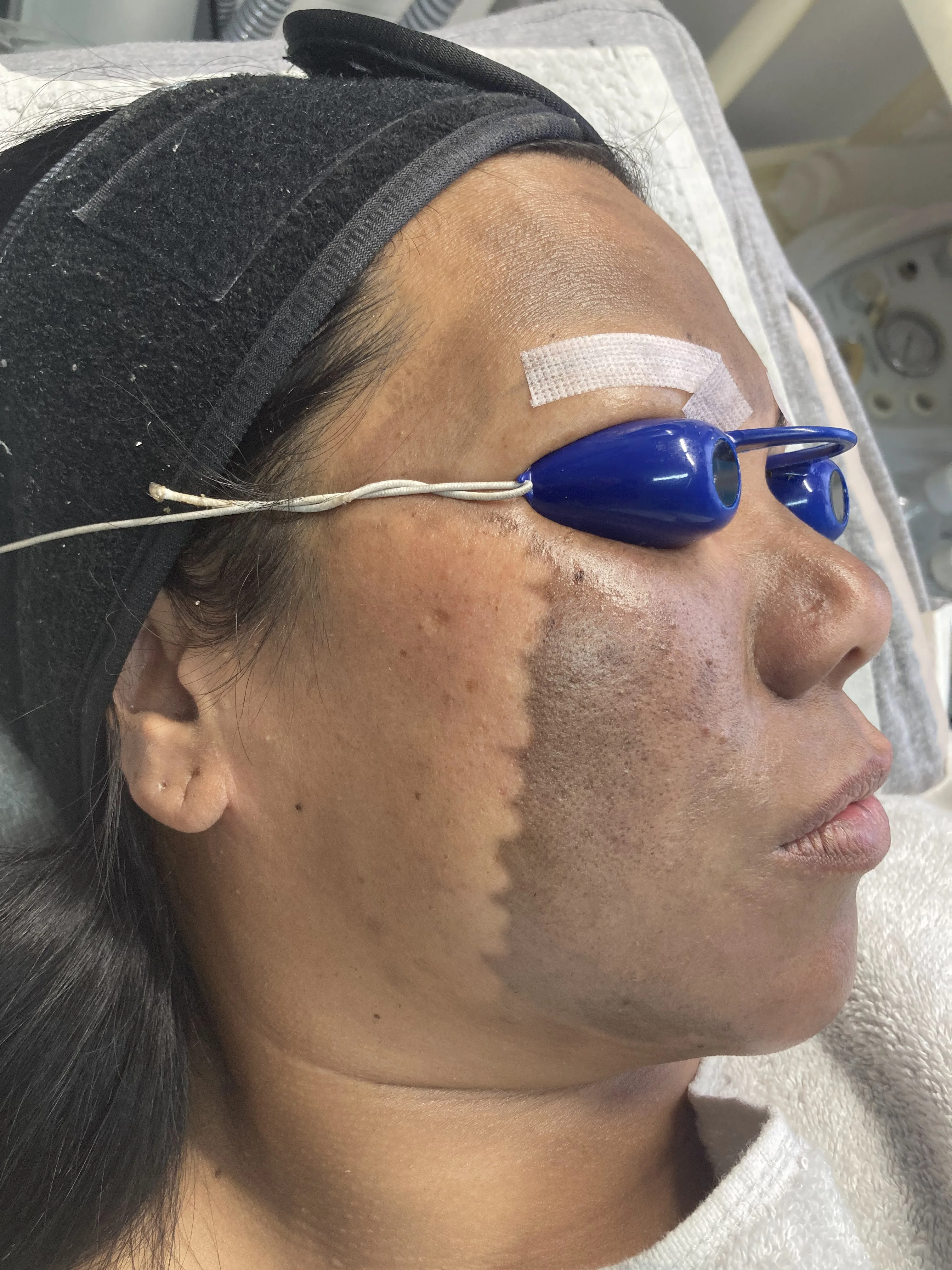 A client in profile under blue eye shields, cheek visibly lightened along a treatment boundary — IPL pigmentation work mid-session